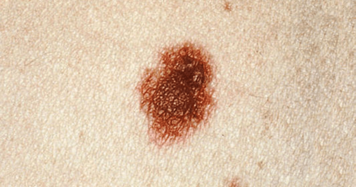 A person with a irregular mole.