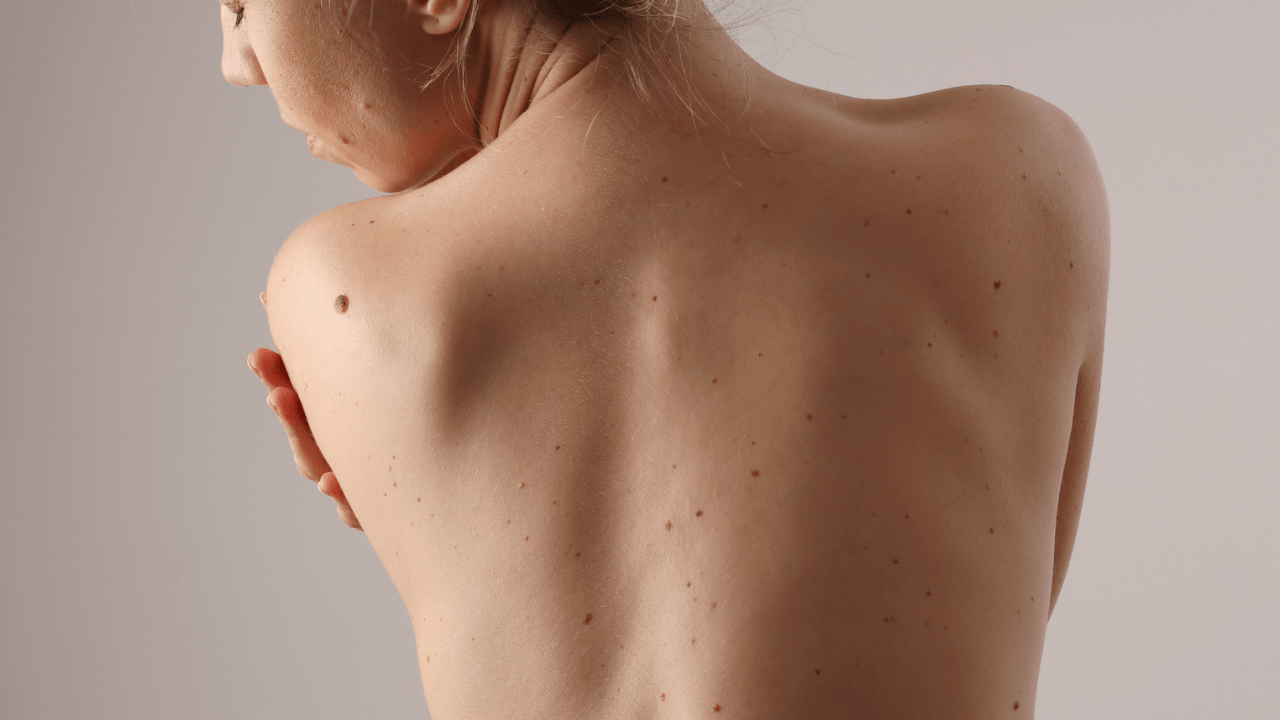 A woman with numerous freckles and a mole on her back, standing in natural light.