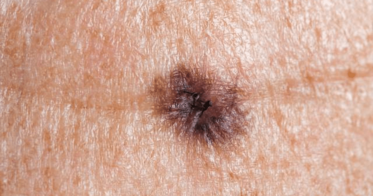 Image of melanoma on the skin.