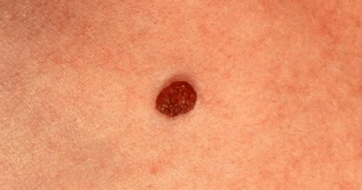 A close-up image of a mole on the skin of a person.